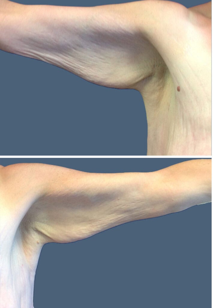 Before body