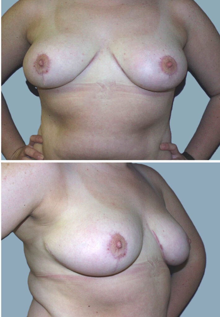 After breast, DD to C cup