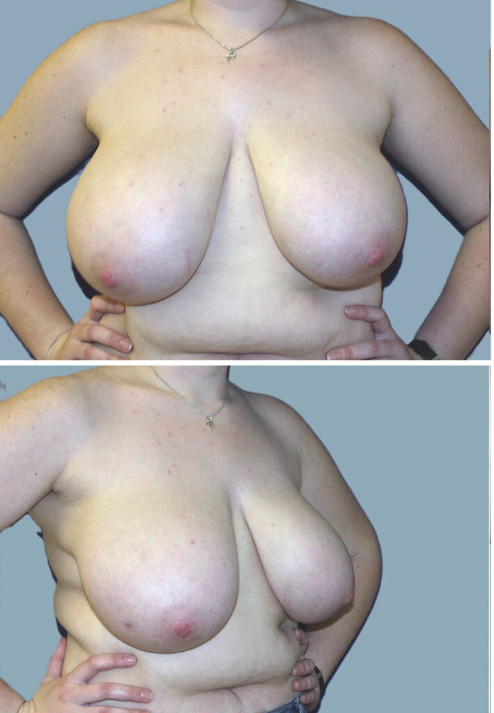 Before breast, DD to C cup