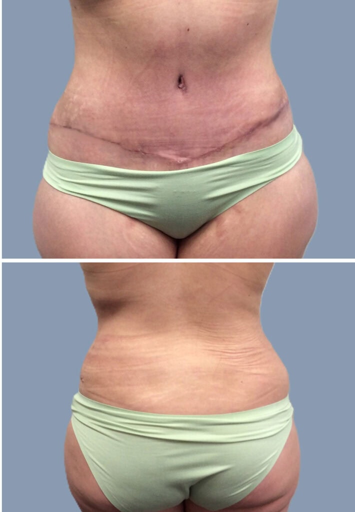 After body