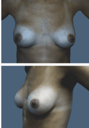After breast, 285cc, A to B cup