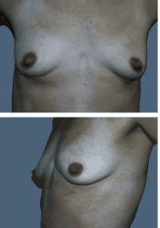 Before breast, 285cc, A to B cup