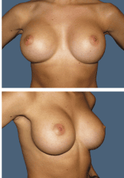 After breast, 300cc, B to C cup