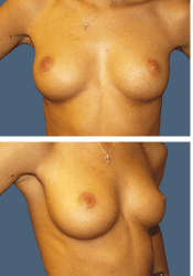 Before breast, 300cc, B to C cup