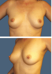 Before breast, 380cc, A to B cup
