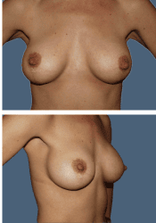 After breast, 300cc