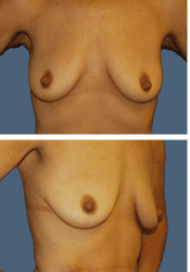 Before breast, 300cc