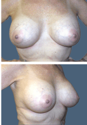 After breast, 380cc, C to D cup