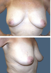 Before breast, 380cc, C to D cup