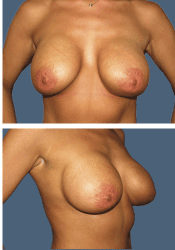 After breast, 450cc, C to D cup
