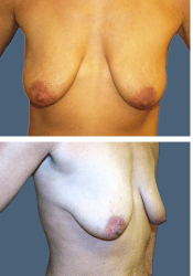 Before breast, 450cc, C to D cup
