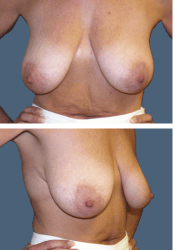 Before breast, 380cc