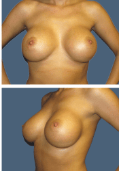 After breast, 380cc, C to DD cup