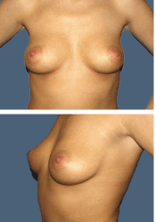 Before breast, 380cc, C to DD cup