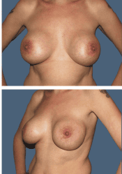 After breast, 450cc, A to DD cup