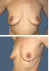 Before breast, 450cc, A to DD cup
