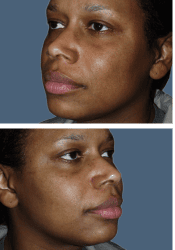 Before facial
