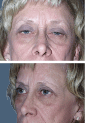 Before facial