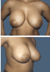 After breast, 560cc, C to DD cup