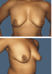 Before breast, 560cc, C to DD cup