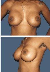 After breast, 450cc, A to DD cup