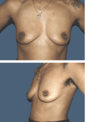 Before breast, 450cc, A to DD cup