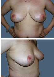 After breast, DDD to D cup