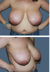 Before breast, DDD to D cup