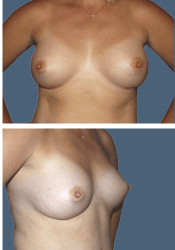 After breast, 450cc, B to C cup