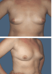 Before breast, 450cc, B to C cup