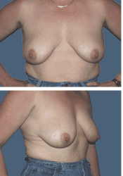 Before breast, 560cc, B to DD cup