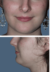 Before facial