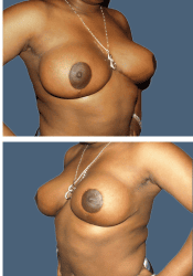 After breast, F to D cup