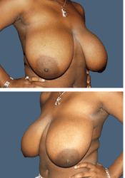 Before breast, F to D cup