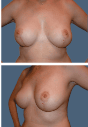 After breast