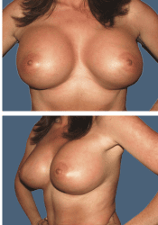 After breast, 620cc, B to DD cup