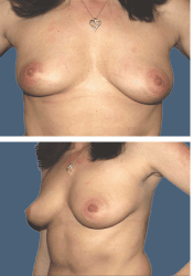 Before breast, 620cc, B to DD cup