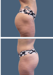 After body