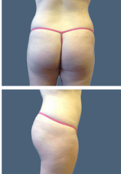 After body