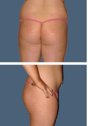 Before body