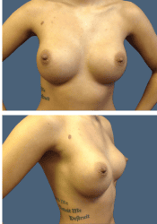 After breast, 400cc, A to D cup