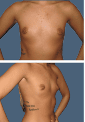 Before breast, 400cc, A to D cup