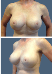 After breast, 500cc, B to D cup