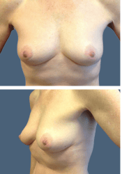 Before breast, 500cc, B to D cup