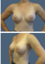 After breast, 360cc, A to D cup