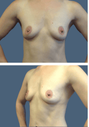Before breast, 360cc, A to D cup