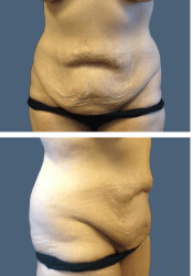Before body