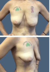 Before breast, 500cc