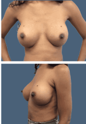 After breast, 500cc, B to D cup