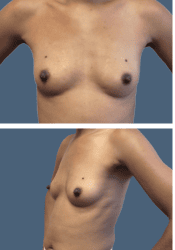 Before breast, 500cc, B to D cup